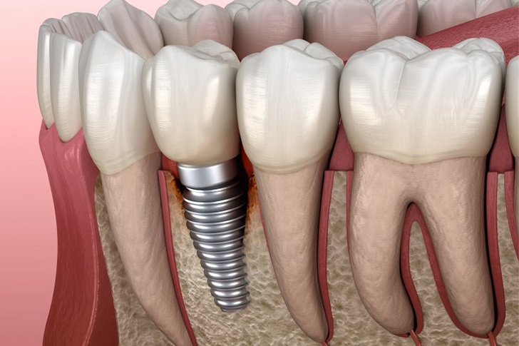 Guide to Affordable Dental Implants for Seniors in 2025