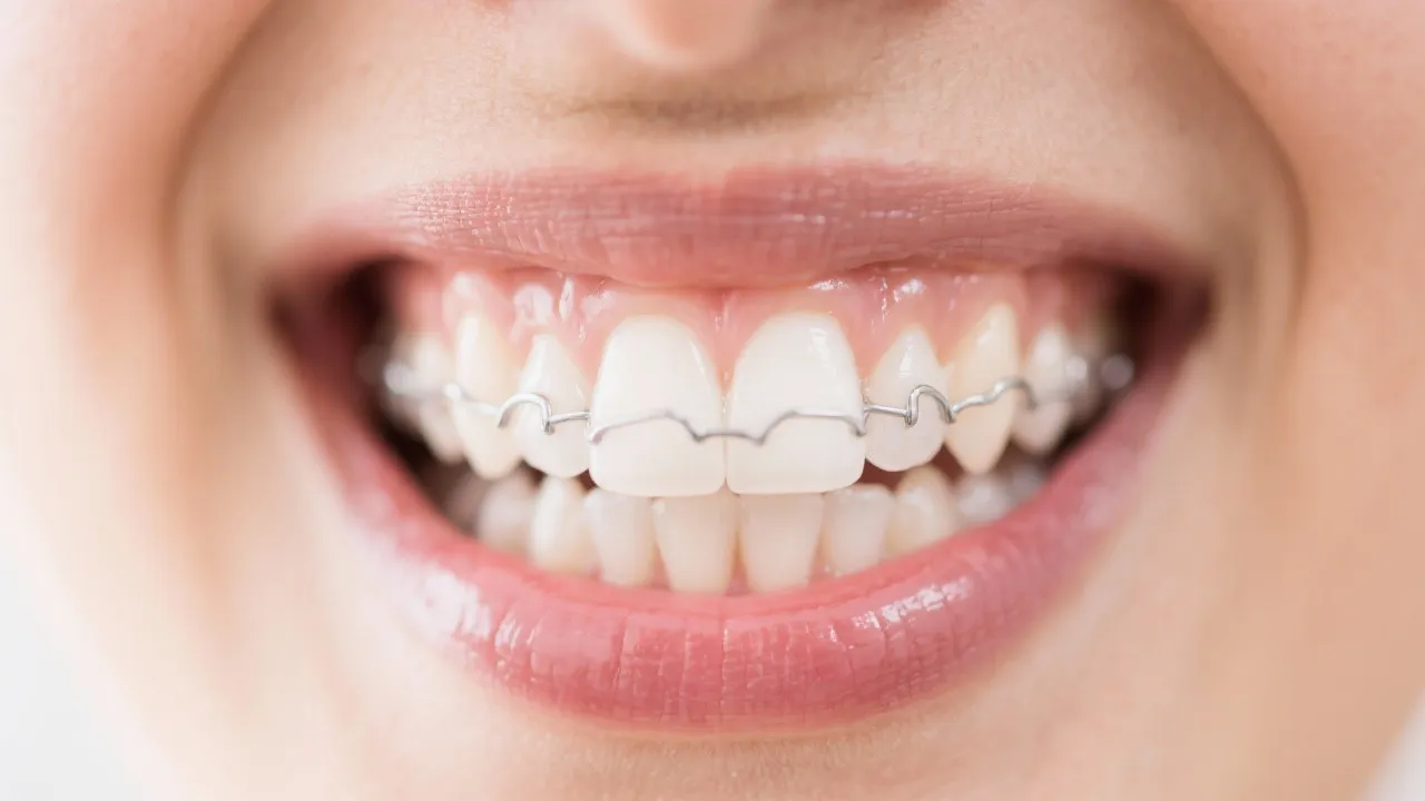 Invisalign in Orthodontics