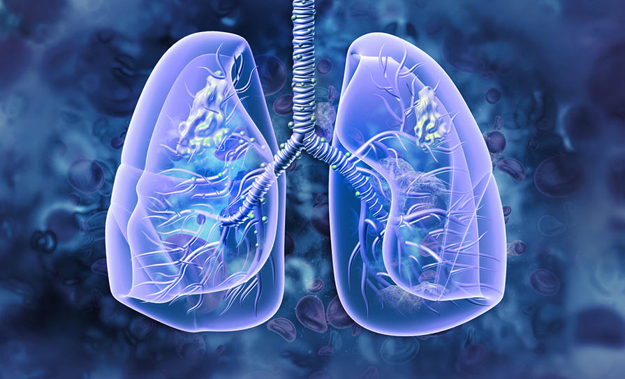 Navigating NSCLC: Tips for Immunotherapy Treatment Success